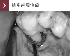 精密歯周治療