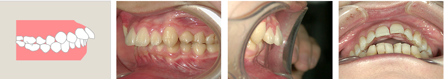 上顎前突（出っ歯）