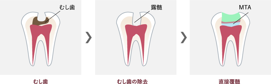 直接覆髄