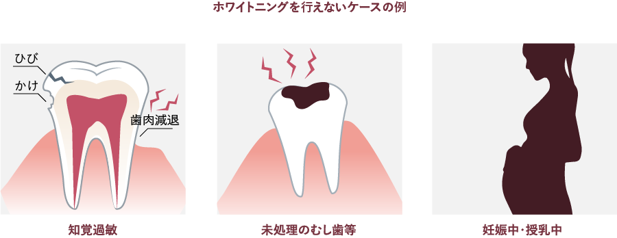 知覚過敏、未処理のむし歯等、妊娠中・授乳中