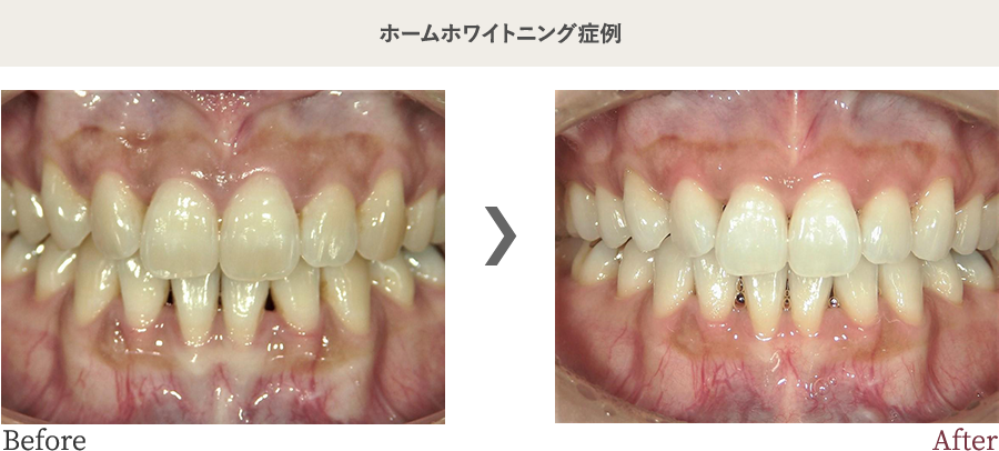 ホームホワイトニング症例