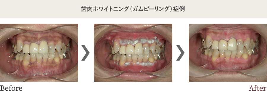 歯肉ホワイトニング（ガムピーリング）症例