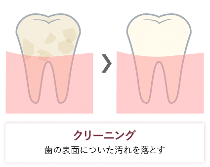 クリーニングとホワイトニング