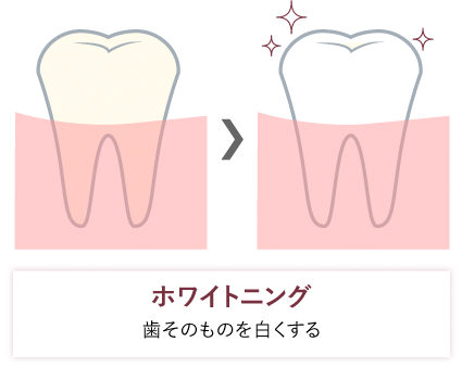 クリーニングとホワイトニング