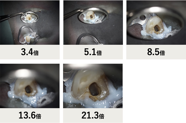 マイクロスコープが必要な理由｜マイクロスコープによる歯科治療ならあべ歯科へ
