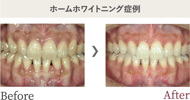 ホームホワイトニング症例