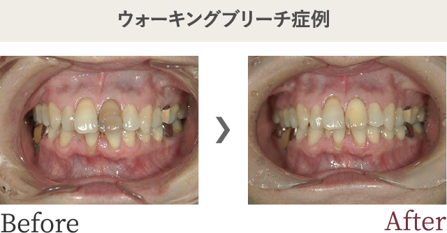 ウォーキングブリーチ症例