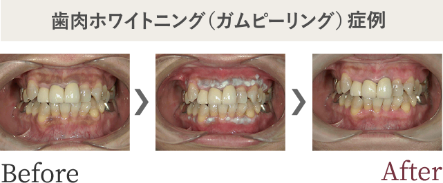 歯肉ホワイトニング（ガムピーリング）症例