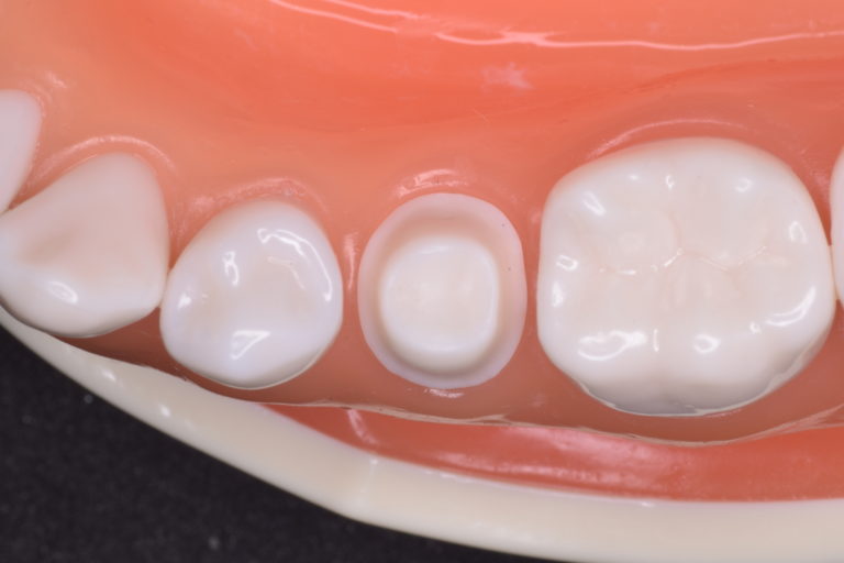 再製のない修復治療のために①・・・スムーズな支台歯形成|世界レベルの精密むし歯治療ならあべ歯科へ 再製のない修復治療のために①・・・スムーズな支台歯形成|世界レベルの精密むし歯治療ならあべ歯科へ